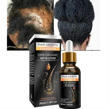 NOVO Alopecia Tratamento de Cabelo para as Mulheres, o Crescimento do Cabelo, Óleo de Rápida HairGrowth a Queda de cabelo Soro